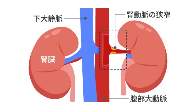 腎血管性高血圧を説明する図です