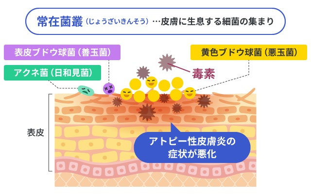 アトピー性皮膚炎を悪化させる皮膚の常在菌叢の働きを示した断面図。表皮ブドウ球菌などの善玉菌に対し、悪玉菌の黄色ブドウ球菌が毒素を放出して皮膚の炎症を悪化させる仕組みを菌のイラストで解説しています。