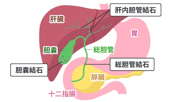 胆石症を説明する図です