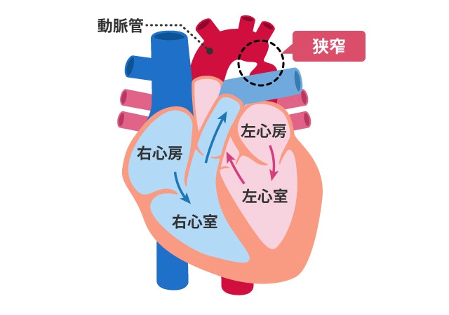大動脈縮窄症を説明する図です