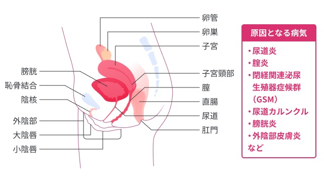 女性で尿道の出口が痒い場合は、尿道やその周囲に炎症があると考えられます。