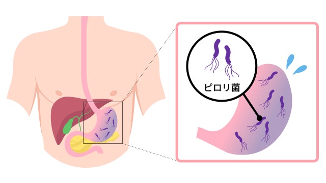 胃とピロリ菌のイラスト