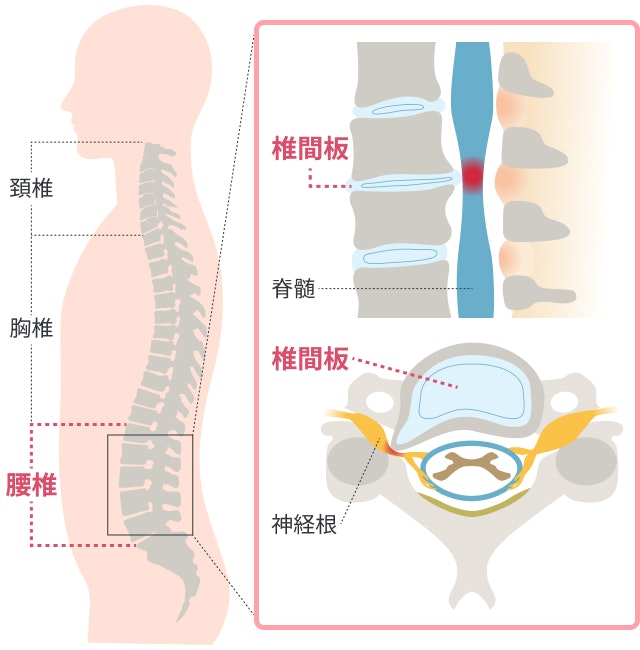 腰椎症を説明する図です