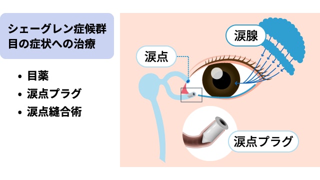 シェーグレン症候群における目の乾燥症状への治療法を示した解説図。点眼薬の使用に加え、涙の流出口を塞ぐ涙点プラグや涙点縫合術の仕組みを、眼球と涙腺の断面図を用いて具体的に図解。