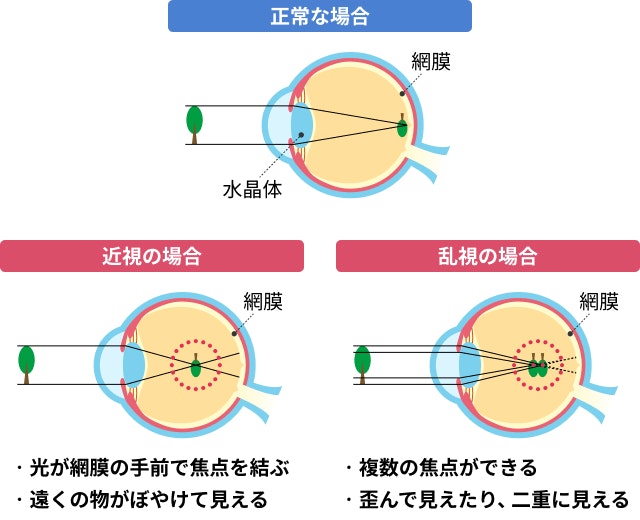 近視と乱視を説明する図です