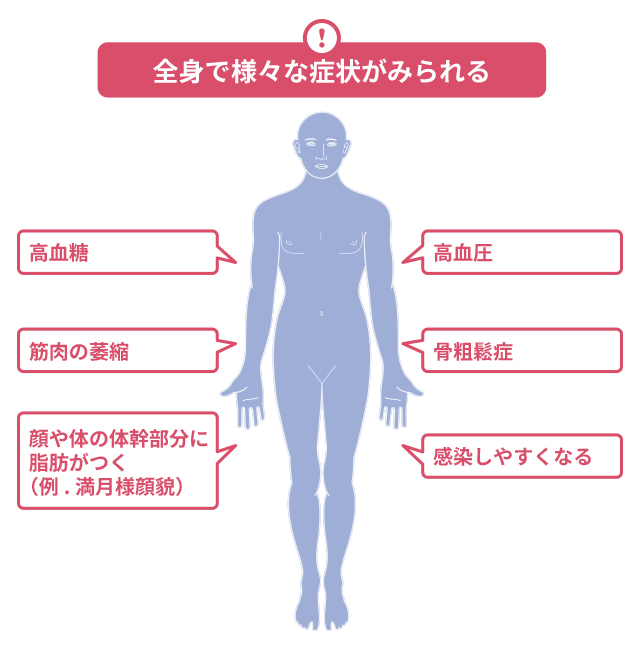 クッシング症候群ではどのような症状がありますか？ ｜クッシング症候群