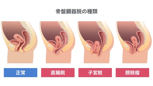 直腸脱がどんな病気か説明する図です