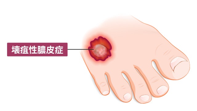 壊疽性膿皮症で見られる皮膚の状態を表した図です。