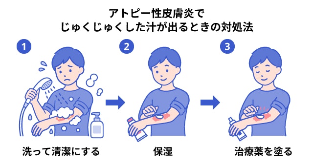 アトピー性皮膚炎で患部からじゅくじゅくとした汁が出た際の正しい対処法の3ステップ（1.洗って清潔にする、2.保湿剤を塗る、3.治療薬を塗る）を、イラストを用いて順番に解説した図。