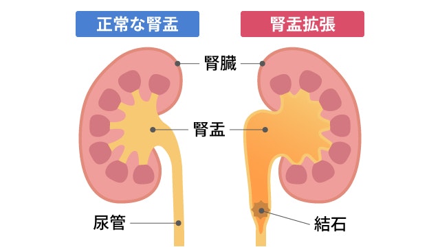 腎盂拡張を説明する図です