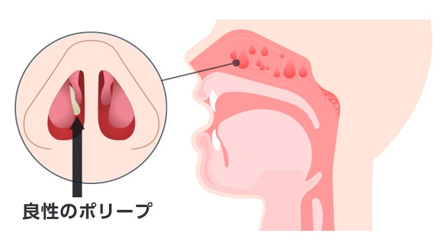 鼻茸が鼻の中でどのようにできているかの図です