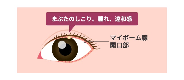 マイボーム腺梗塞において、まぶたの縁のマイボーム腺開口部に脂が詰まり、白や黄色みを帯びた小さなしこりができている状態を示す目のイラスト。自覚症状が現れる部位を具体的に描写しています。