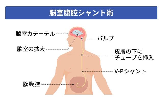 水頭症の治療