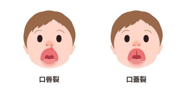 口唇裂と口蓋裂において、唇や上あごがどのような状態になっているかを示す比較イラスト。左側は上唇が裂けている口唇裂、右側は上あごが裂けている口蓋裂の乳児の顔を描き並べています。