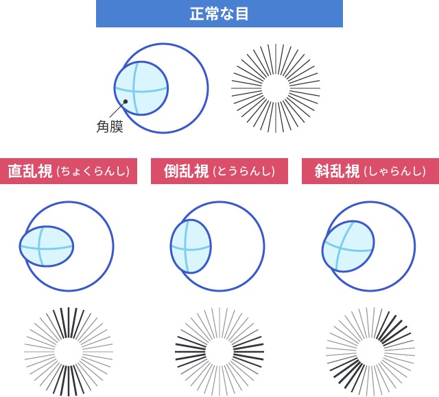  乱視の人の目について説明する図です