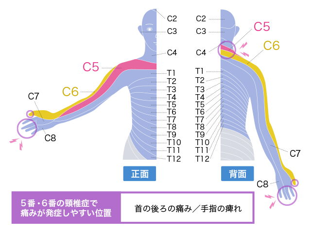 5番・6番の頚椎の間の頚椎症ではどのような症状がありますか？ ｜頚椎症