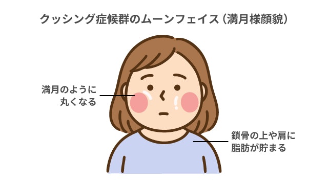 ムーンフェイスを説明する図です