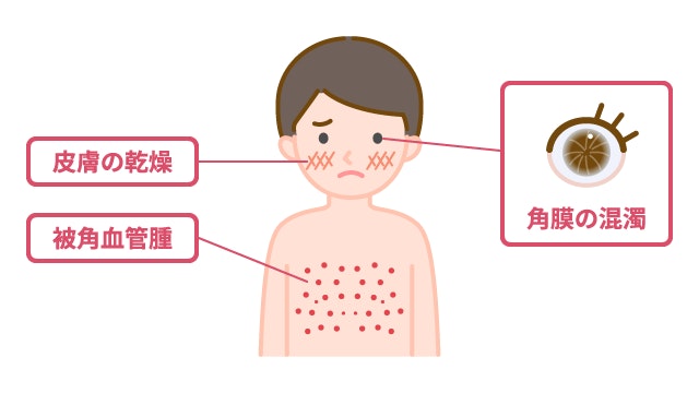 ファブリー病の患者に子どもの頃から見られる、3つの特徴的な身体所見。「皮膚の乾燥」、腹部や陰部などに左右対称に現れる赤い発疹「被角血管腫」、角膜が渦巻き状に濁る「角膜の混濁」を描いたイラスト。