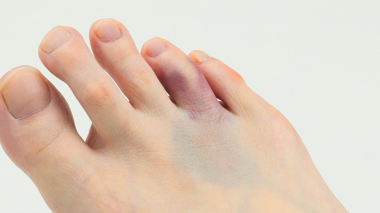 打撲傷を説明する図です