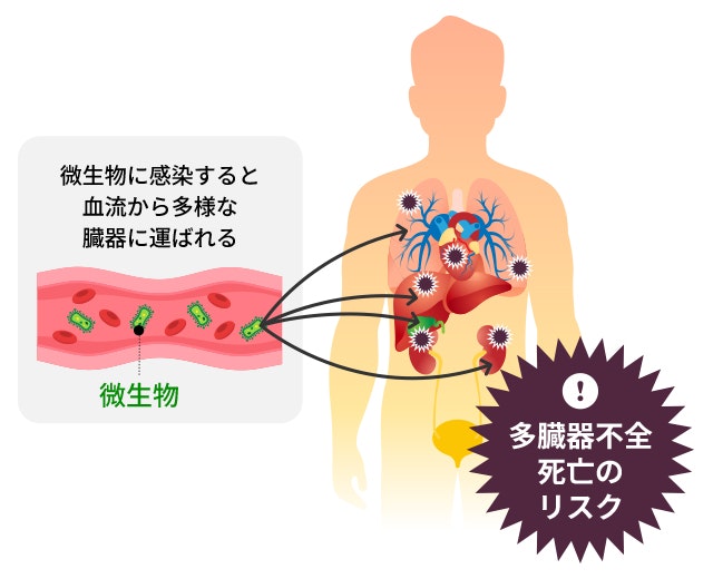 敗血症を説明するイラスト