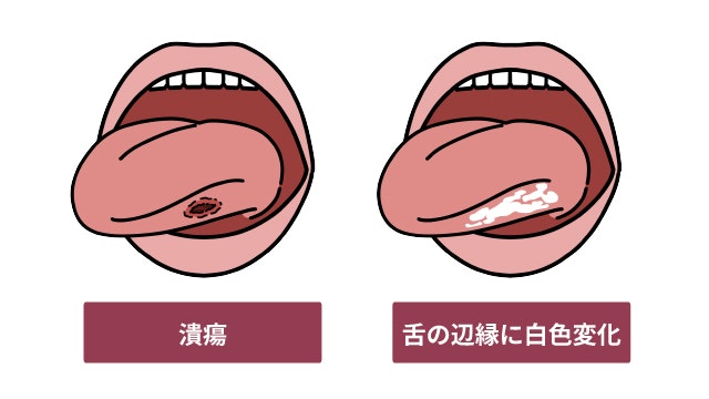 舌癌の見た目のイラスト