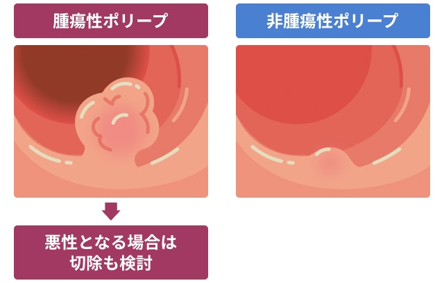 腫瘍性ポリープと非腫瘍性ポリープを説明する図です