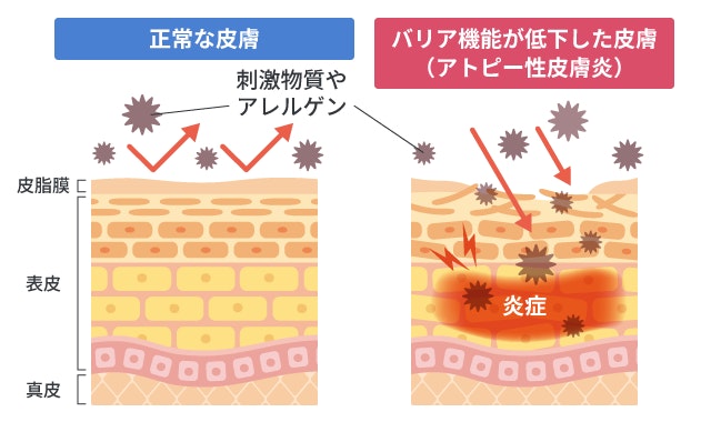 アトピー性皮膚炎による皮膚のバリア機能低下を、正常な皮膚と比較した断面図。皮脂膜や表皮が乱れ、アレルゲンなどの刺激物質が皮膚内部へ侵入して強い炎症を引き起こしている状態をイラストで分かりやすく示しています。