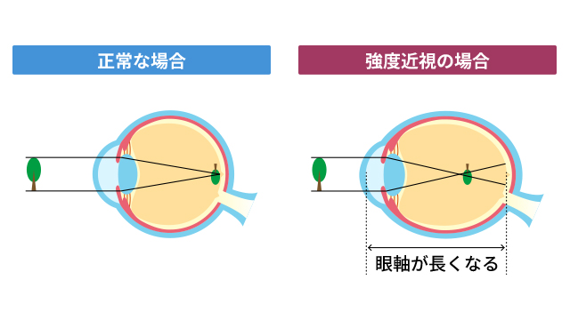 近視の状態を説明する図です