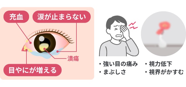 角膜潰瘍の症状を説明する図です