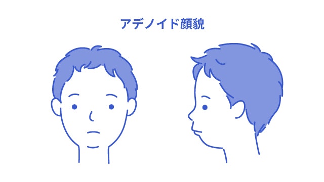 アデノイド顔貌を説明する図です