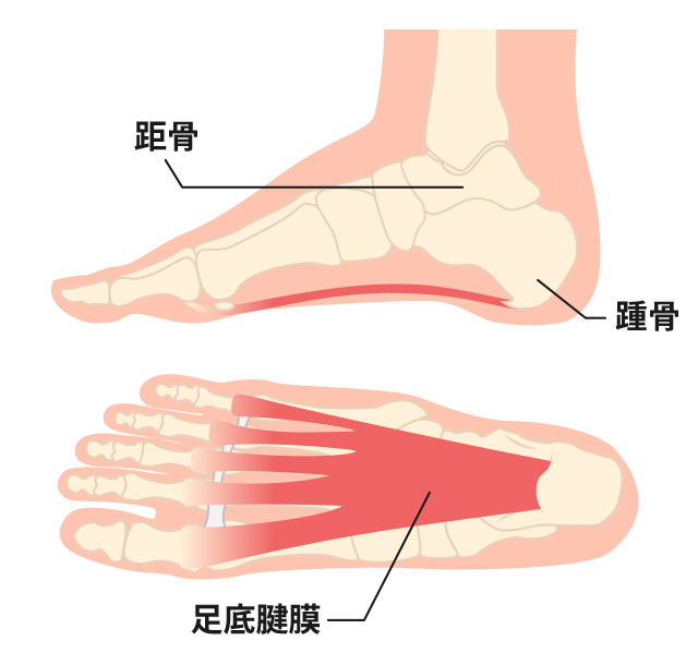 かかとの横を押すと痛い場合、何が考えられますか？ ｜かかとが痛い