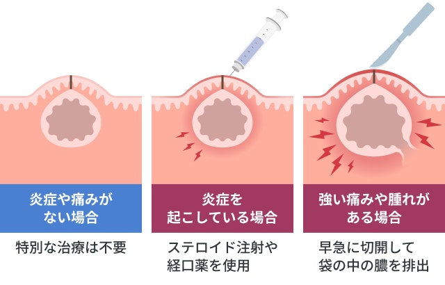 粉瘤の治療を説明する図です