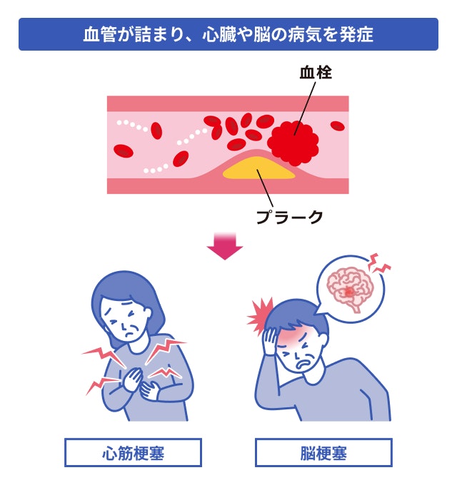 ホモ接合体家族性高コレステロール血症で血管が詰まると発症する病気を説明する図です