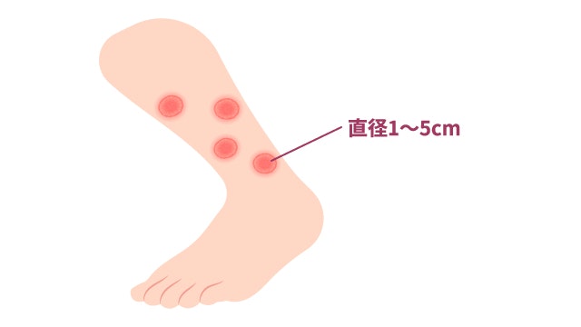 貨幣状湿疹を説明する図です