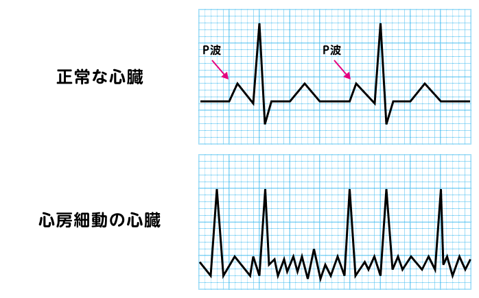 心房細動と正常な心電図の違いを説明する図です
