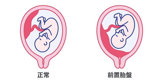 前置胎盤と正常な状態を、子宮と胎児のイラストを用いて比較しています。正常では胎盤が子宮上部にあり、前置胎盤では胎盤が子宮の出口を覆い塞いでしまっている違いを説明しています。