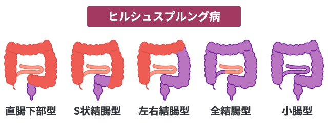 ヒルシュスプルング病において、神経節細胞が欠損している腸管の範囲(無神経節腸管)の範囲を示す分類比較図。直腸下部型から小腸型まで、病変部を紫色で表した大腸のイラストで図解しています。