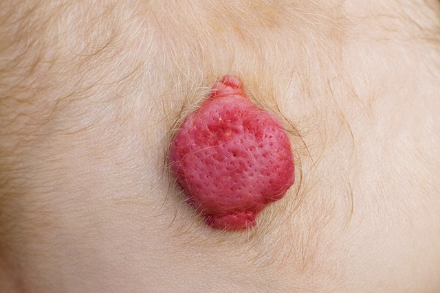 苺状血管腫について説明する図です