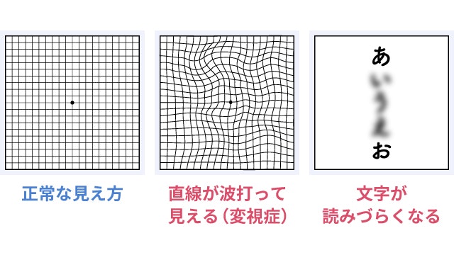 黄斑前膜の見え方にについて説明する図です