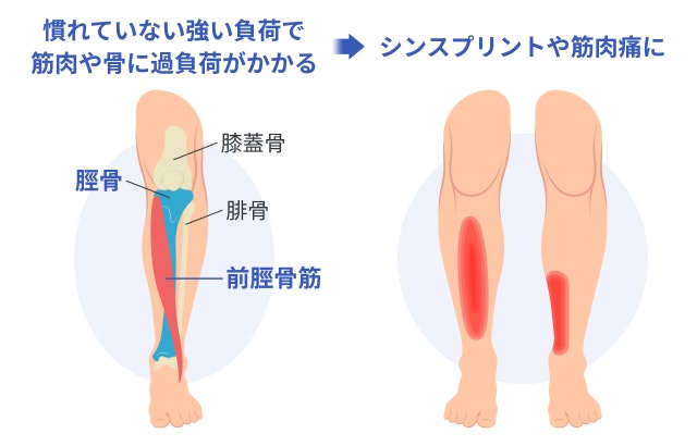 シンスプリント（脛骨過労性骨膜炎）や筋肉痛を説明する図です