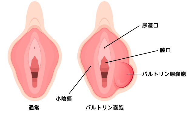 バルトリン腺の場所を説明する図です