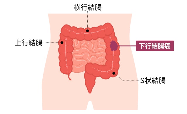 下行結腸の位置がわかるイラスト