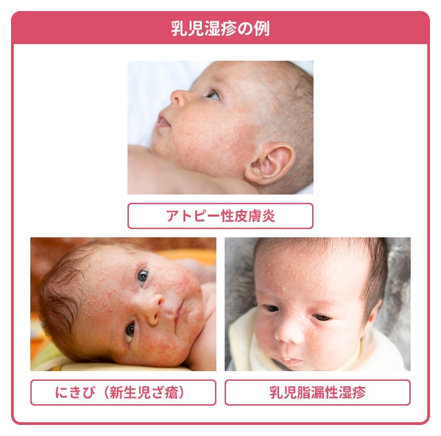 乳児湿疹とアトピーの違いについて説明する図です