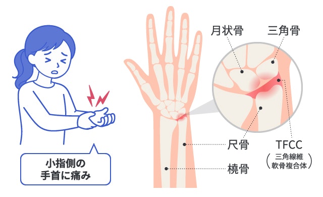 尺骨突き上げ症候群の症状について説明する図です