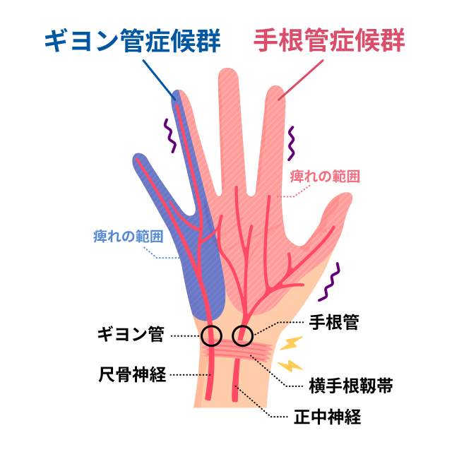 薬指しびれ コレクション 腕枕