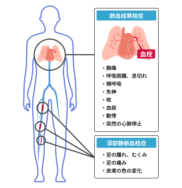 Amazon.co.jp: 臨床医のための静脈血栓塞栓症(深部静脈血栓症