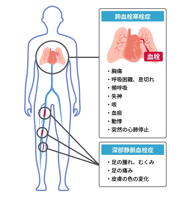 静脈血栓塞栓症の症状のイラストです