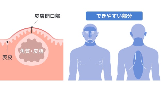 粉瘤を説明する図です