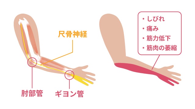 尺骨神経麻痺を説明する図です