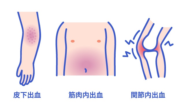 血友病の皮下出血、筋肉内出血、関節内出血を説明する図です